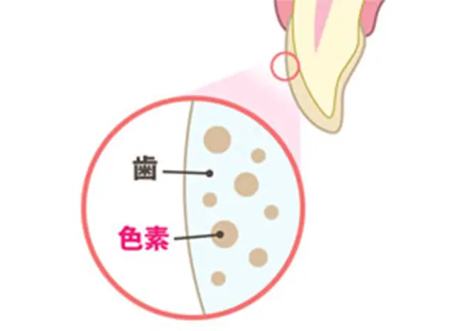 歯の黄ばみや着色汚れが目立つ状態