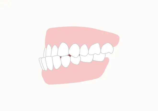 下顎前突（受け口・反対咬合）